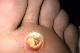 “鸡眼”足底的肉刺你了解吗？图片
