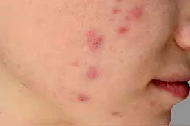 家用红蓝光治疗仪靠谱吗？能有效治疗痤疮吗？图片