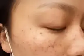 中老年朋友出现“色素沉着”和斑点不要急，试试这些方法改善。图片