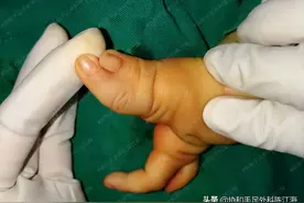 并指免植皮 | 案例3《并指合并裂手，手术后有了一双灵活的手》图片