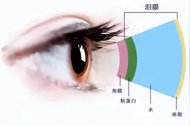 别再戴着隐形眼镜睡觉了！小心你的眼睛变成这样？图片
