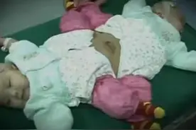 湖北夫妻生下一对奇特连体婴，分不清孩子性别，医生看了也叹气图片