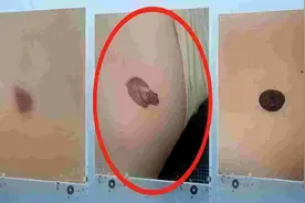 可能癌变！身上有这种痣的要当心！速自查→图片