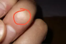 “瘊子”被自己干掉了，哈哈！这回聪明了，比医院便宜太多图片