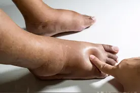 老年人出现腿、脚肿胀别忽视，这5种常见的病因，逐条给您讲清楚图片