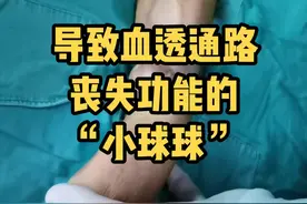 导致血透通路丧失功能的“小球球”----不是所有的问题都是微创腔内介入方法能完全解决的#医学科普 #血透 #肾功能不全 #尿毒症晚期 @DOU+小助手 视频封面