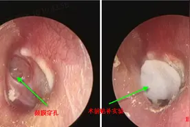 耳朵流脓，发现鼓膜穿孔了，该怎么办图片