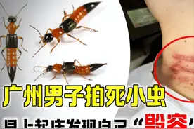 广州男子拍死一只小虫子，第二天起床发现自己毁容，半边脸变了样图片