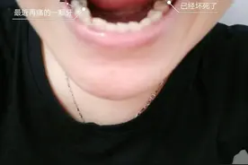 难道只有我20岁的牙坏成这样吗？？？图片