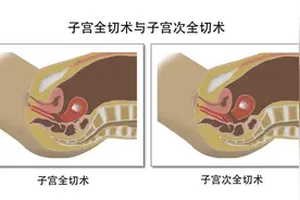子宫切除的利弊是什么？图片