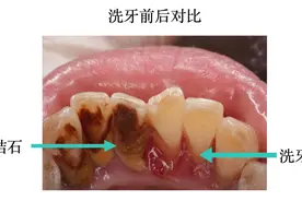什么是牙石（或牙结石）？图片
