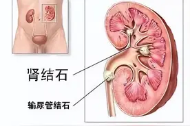 忠言逆耳：肾结石千万不能拖，尤其是已经积水了图片