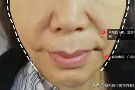 口角囊袋怎么去除好？听听医生怎么说图片