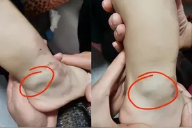 4岁男孩右下肢增粗，患KT综合征，介入微创治疗病例图片