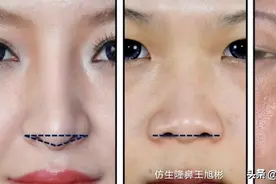 如何定义短鼻？短鼻延长＆挛缩鼻矫正修复案例图片