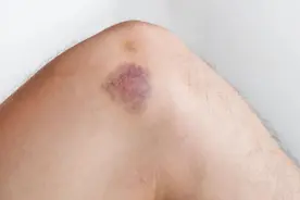 为什么身上经常青一块紫一块的？背后的原因终于找到了……图片