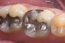 四大补牙材质大揭秘，你选对了吗？图片