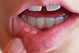 20多年的口腔溃疡治疗经历，愿与您分享图片