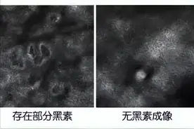「被证实了」多吃黑色食物，多补黑色素，白癜风能自愈图片