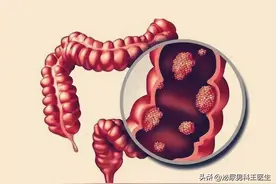肠癌多是“拖”出来的，出现3种迹象，肠道已“病”得不轻图片