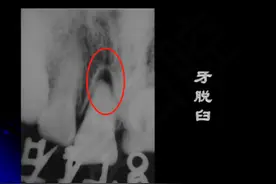 牙齿损伤移位不要怕，正确处理方法一定要牢记图片