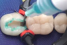 补牙后牙痛怎么回事？是医生没补好，还是把牙「补坏了」？图片