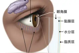 了解干眼症：让眼里常含泪水，别对屏幕爱得深沉图片