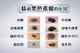 知名歌手因患黑色素瘤去世，这样的“痣”要当心！图片