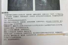 “肝囊肿”一定要手术吗，中医活血化瘀，软肝散结消囊肿！图片