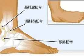 崴脚几个月都好不了，问题可能出在高位踝扭伤，拖下去就麻烦了图片