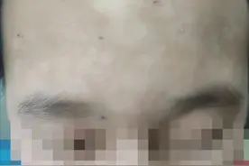 12岁男孩面部脱皮、长脓疱，竟是“脚气”上脸了！这个细节很多人忽略图片