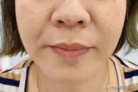三甲整形医生：给30岁-50岁想打玻尿酸改善法令纹的人，5个忠告！图片