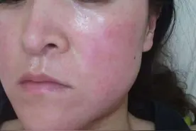 什么是激素脸？烂脸后要怎么修复？图片