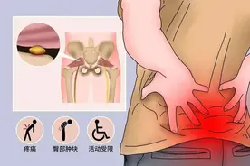 屁股疼就一定是腰突吗？小心梨状肌综合征图片