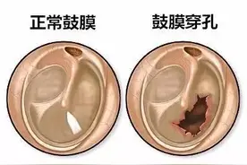 同样是外伤性鼓膜穿孔，为什么有人构成轻伤，有人构成轻微伤？图片