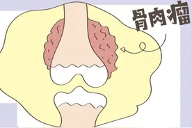 15岁男孩患骨肉瘤，治一半父母听说中医能治好，两年后需要截肢？图片