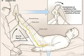 坐骨神经痛 (Sciatica)图片