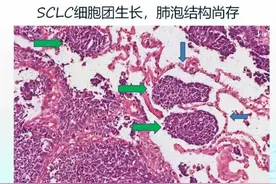 得了小细胞肺癌怎么办？小细胞肺癌应该怎么治疗？图片
