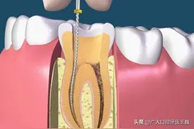 根管治疗｜蛀牙厉害牙太疼，为什么要抽掉我的牙神经？图片
