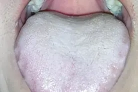 脾虚齿痕舌，参苓白术丸没有用？中医教你巧搭配，作用翻倍图片