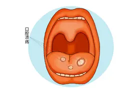 体内有癌，嘴巴4个症状很明显，发现2个以上尽早检查，不能大意图片