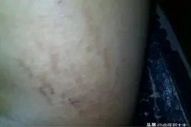 大腿根潮湿，出汗多，有异味怎么回事？一盒中成药，解决三大根源图片