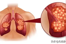 体内有癌，腿先知？提醒：若腿上有4个迹象，建议尽早筛查图片