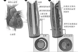 明明做了心脏支架，血管为什么还会堵塞，血管二次堵塞该怎么办？图片