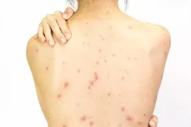 头皮、后背出现很多小疙瘩？这多半与4个因素有关，需及时调理！图片
