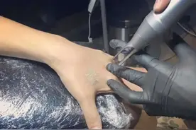 擦伤留下红印半年没有消怎么办？擦伤留下红印半年了如何治疗？图片