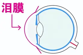 干眼症是“绝症”？！几招教你缓解眼睛干涩图片