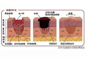 修复疤痕有这些方法，你知道吗？图片