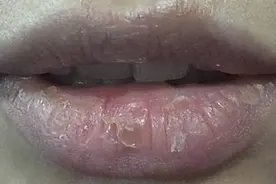 嘴唇不好，要找脾，中医温脾来治唇干裂图片