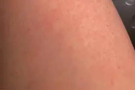 儿童发热后全身起红色疹子是什么病图片